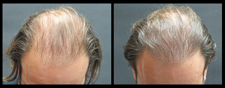 NYC Hair Restoration Before & After