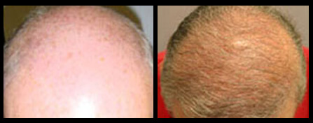Balding Treatment Before And After