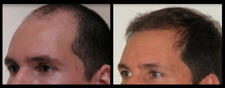 Hairline Restoration Before And After
