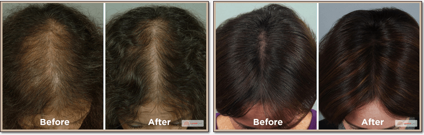 Lasercap LCPRO Laser Hair Restoration Before and After