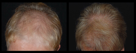Female Hair Restoration Before And After