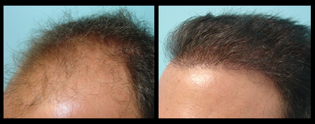 Male Hair Loss Treatment Before And After