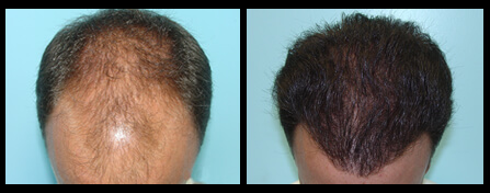 Hair Restoration Before And After