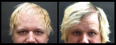 New York City Hair Restoration Before And After Image