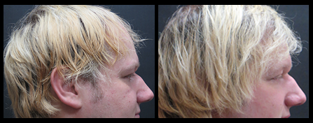 NY Hair Restoration Before And After Image