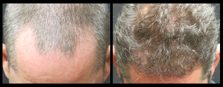 NYC Hair Restoration Treatment Before And After Image