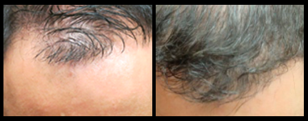 NYC Hair Restoration Procedure Before And After Image