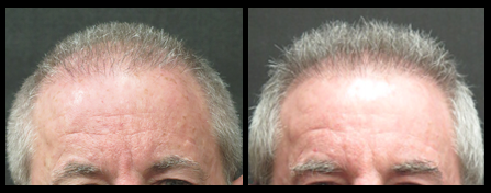 NYC Hair Restoration Surgery Before And After Image