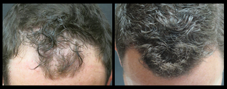 NYC Hair Restoration Doctor Before And After Image
