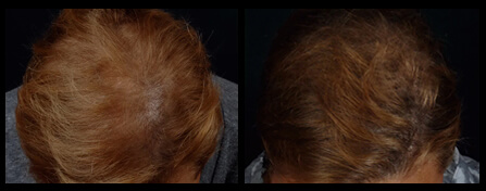 Hair Loss Solution Before And After