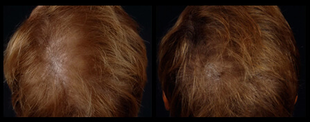 Best Hair Loss Treatment Before And After