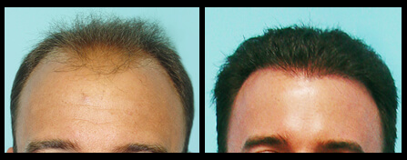 Baldness Treatment Before And After