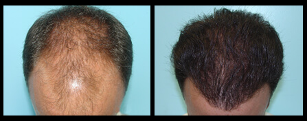 Male Hair Loss Treatment Before And After