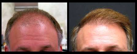 Hair Replacement Before And After