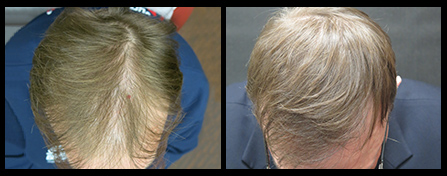 NYC Hair Restoration Before And After