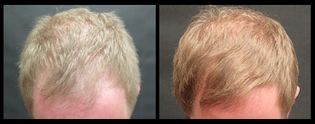 NYC Hair Restoration Before & After Image