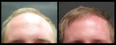 NYC Hair Restoration Before And After Image