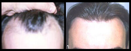 Thinning Hair Treatment Before And After
