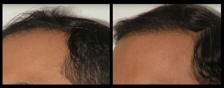 Hair Loss Treatment Before And After