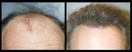Hair Regrowth Treatment Before And After