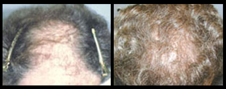 Hair Loss Treatment For Men Before And After