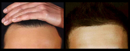 Treatment For Hair Loss Before And After