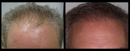 Hair Restoration Before And After