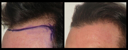 Hairline Replacement Before And After
