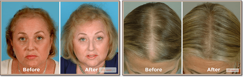 Lasercap Hair Therapy NYC | Laser Hair Restoration For Thinning Hair
